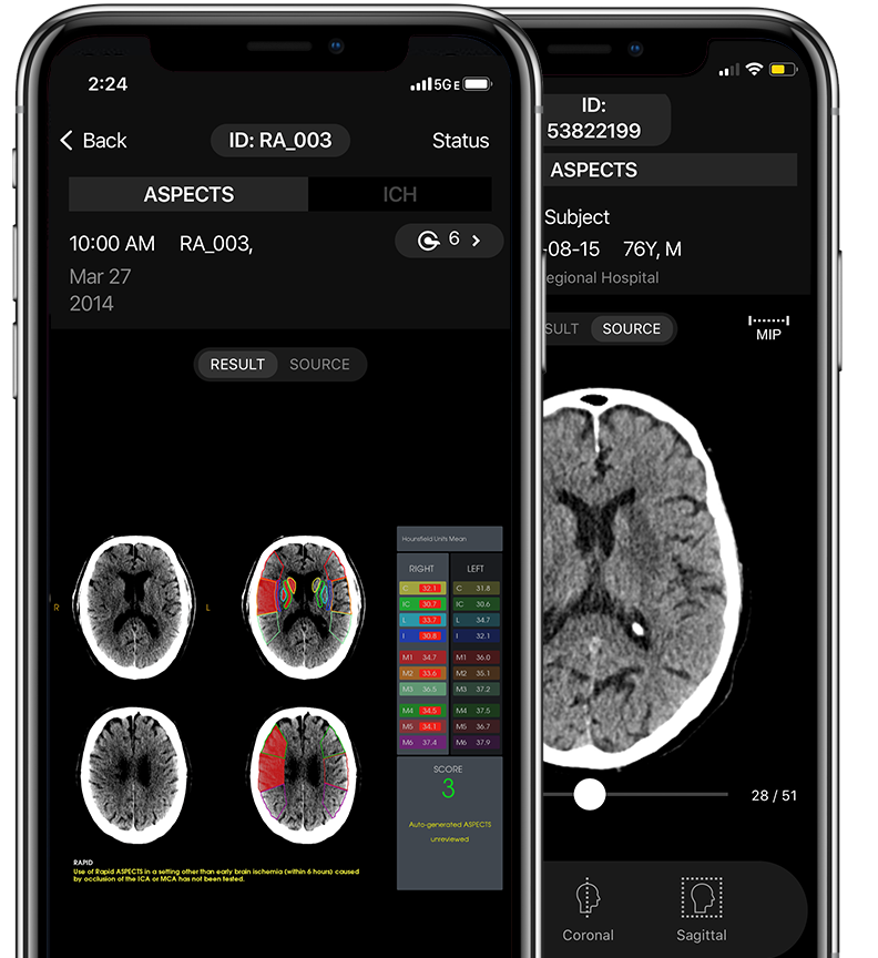 Why RapidAI | Software Platform for Cerebrovascular Disorders