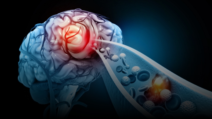 Mechanical ThrombectomyStrokeTreatmentCroatia-LP-1