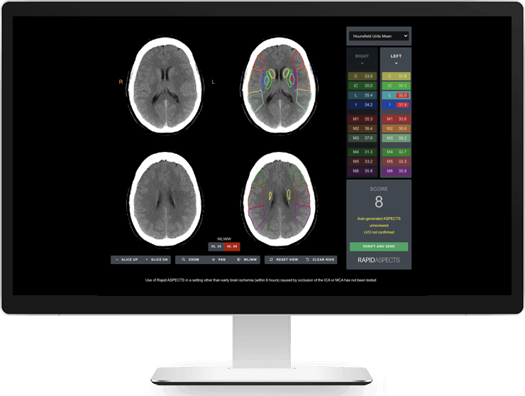 ASPECT Score Stroke Neuroimaging Device - Rapid ASPECTS