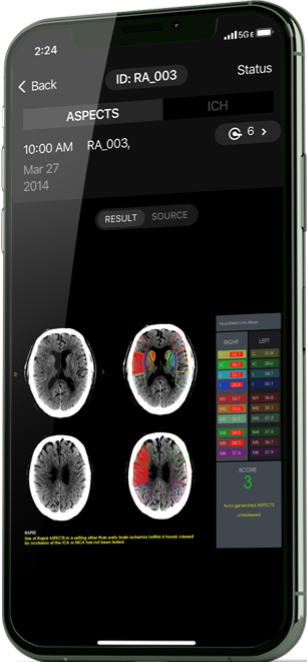 Neuroimaging Stroke Software Platform Powered by AI | RapidAI